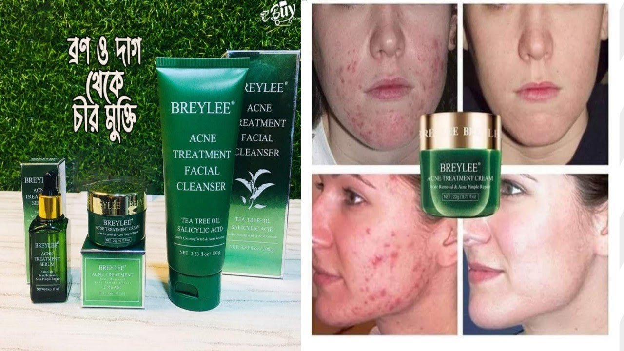 Breylee Acne Treatment Cream - 20g - Image 2